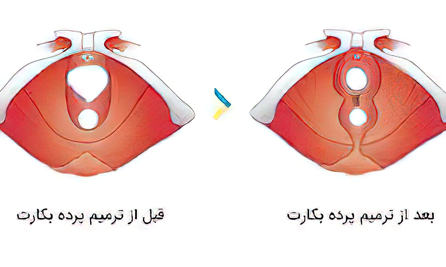 ترمیم پرده بکارت