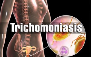 تریکوموناس واژینالیس