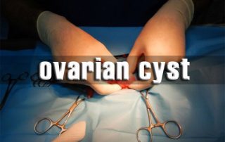 کیست تخمدان