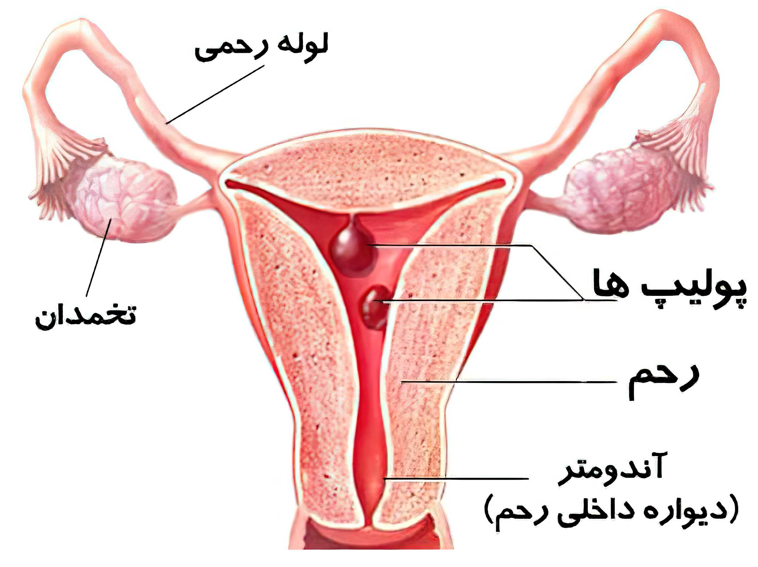 پولیپ رحم در زنان