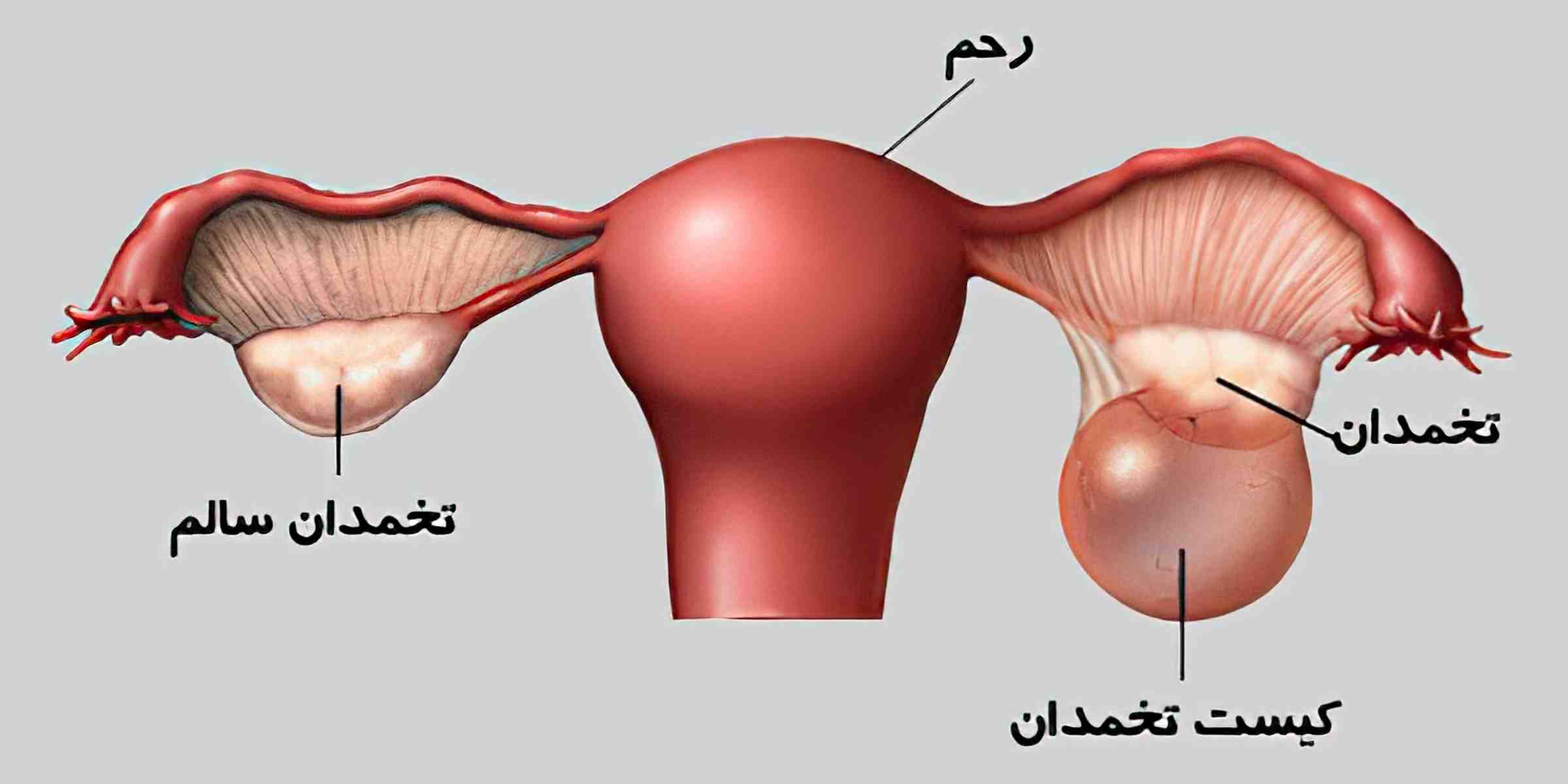 انواع کیست، عوامل ایجاد و نحوه جراحی آن