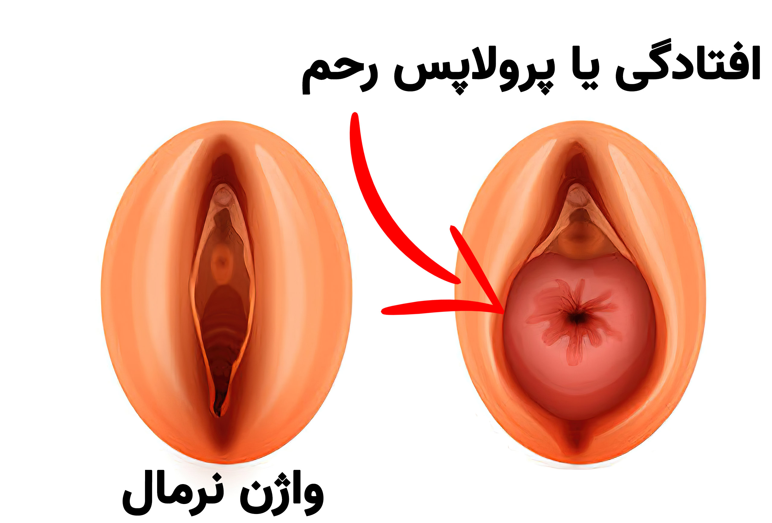 ترمیم رکتوسل یا افتادگی رحم