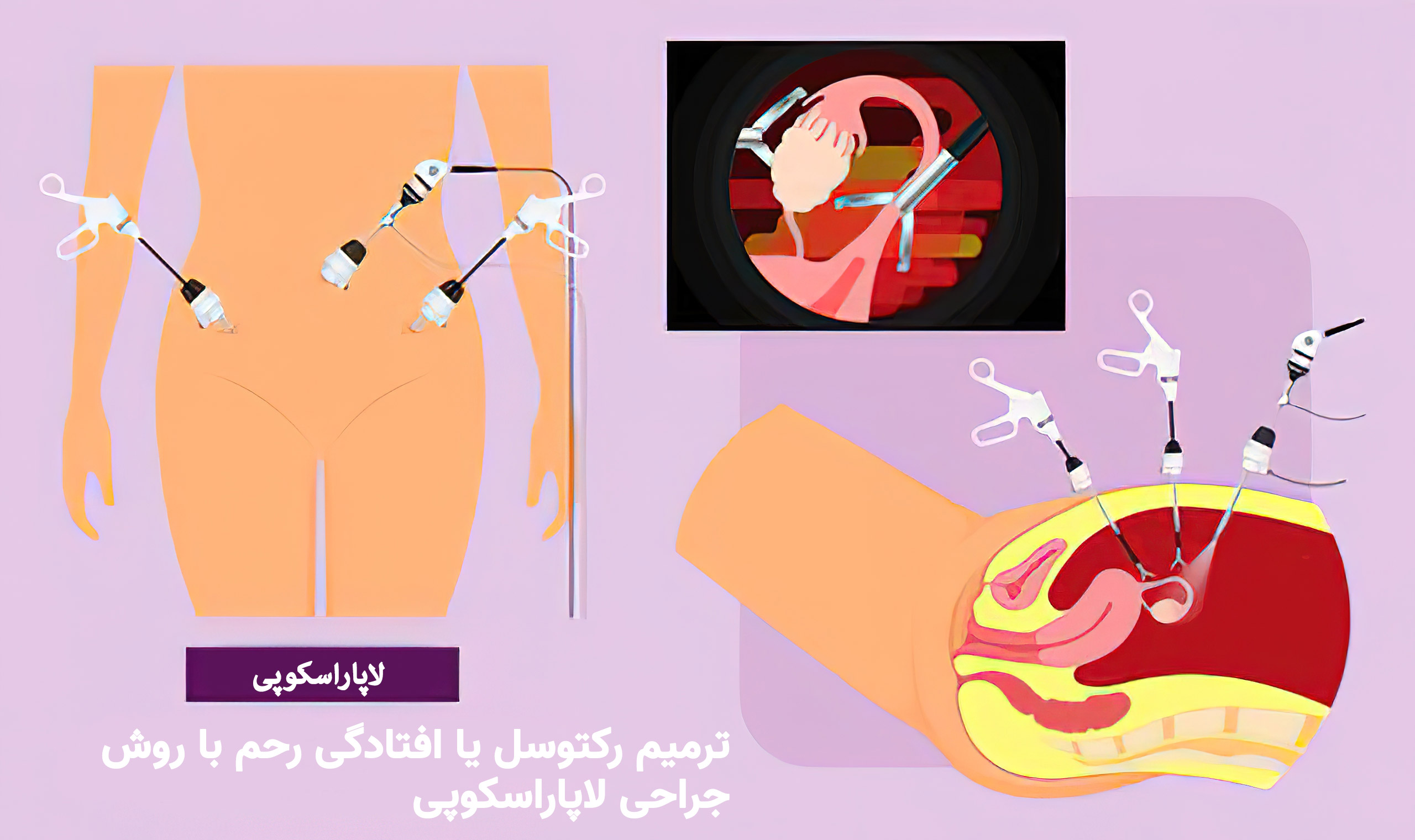 ترمیم رکتوسل یا افتادگی رحم